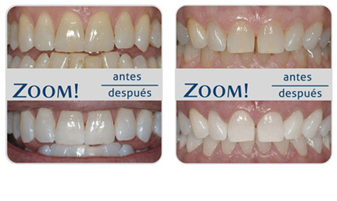 Blanqueamiento Dental