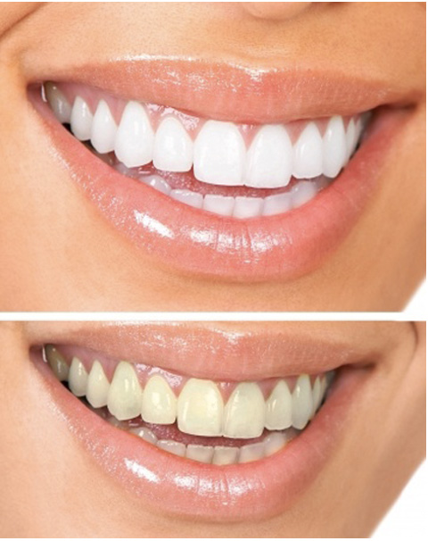 Blanqueamiento Dental