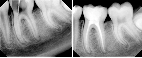 endodonciaC2