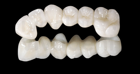 Puentes | Clínica Dental Del Valle